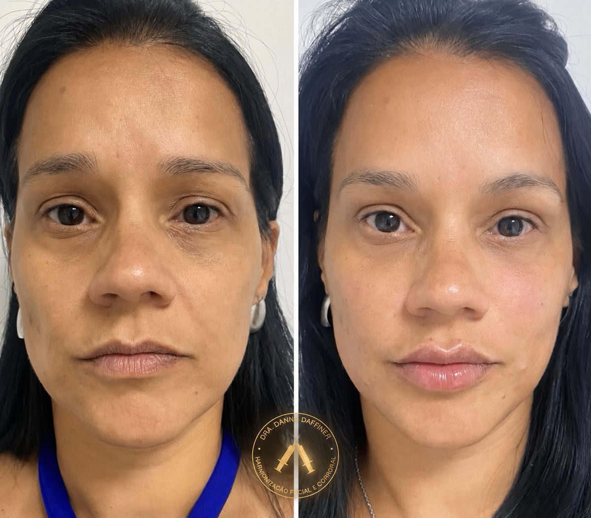 Antes e depois de harmonização facial
